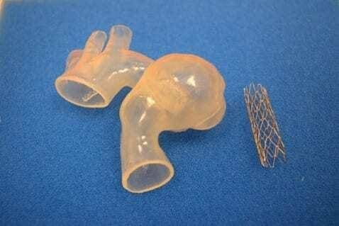 Impressão 3D de biomodelos salvando vidas humanas - Planejamento cirurgico - Angioplastia