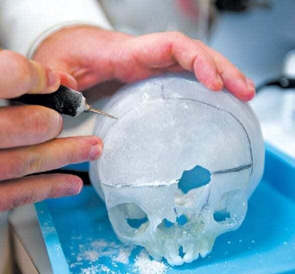 Impressão 3D de biomodelos salvando vidas humanas - Planejamento cirurgico